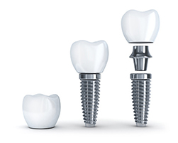 A rendering of a dental implant crown and post Placentia, CA