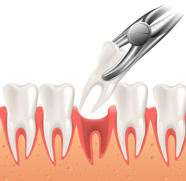 Illustration of a tooth being extracted at Placentia Oral Surgery in Placentia, CA