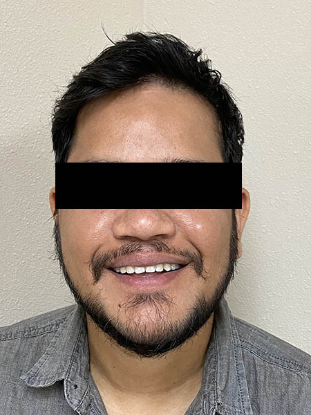 Picture of a man  after jaw surgery