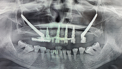 X-ray of a woman  after jaw surgery
