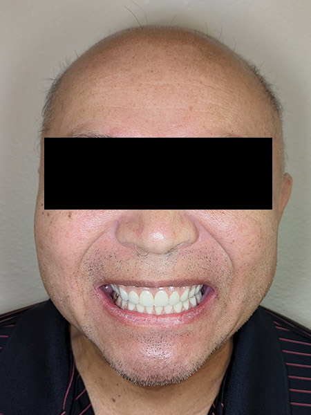 Picture of a man after jaw surgery