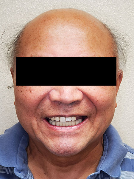 Picture of a man  before jaw surgery