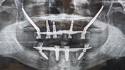 X-ray of a man after jaw surgery