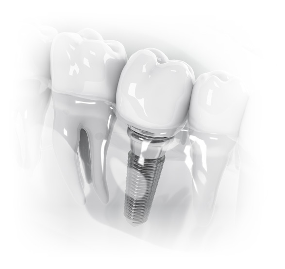 Model of a Dental Implant
