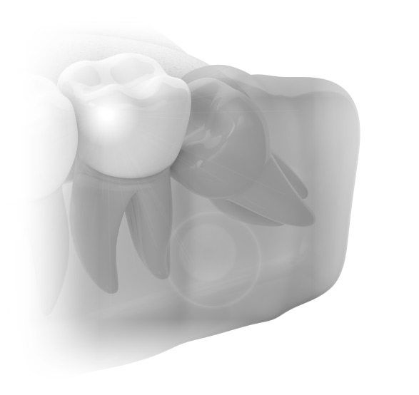 Model of an impacted wisdom tooth