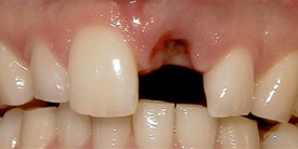 Picture of teeth before procedures