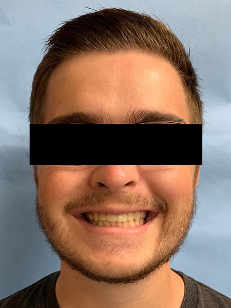 Picture of a man  after jaw surgery