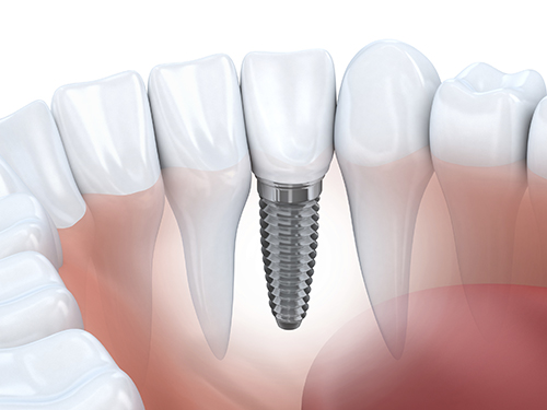 Diagram of Dental Implants from Placentia Oral Surgery in Placentia, CA