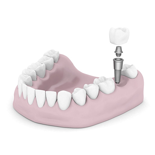 A dental implant model for a bottom tooth from Placentia Oral Surgery in Placentia, CA
