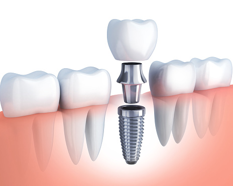 Model of single tooth dental implant  from Placentia Oral Surgery in Placentia, CA