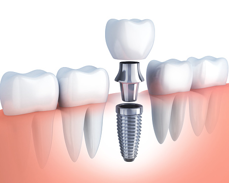 Model of single tooth dental implant from Placentia Oral Surgery in Placentia, CA Model of single tooth dental implant from Placentia Oral Surgery in Placentia, CA