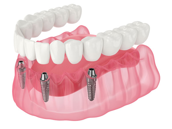 Rendering of All on 4 dental implants in the lower jaw