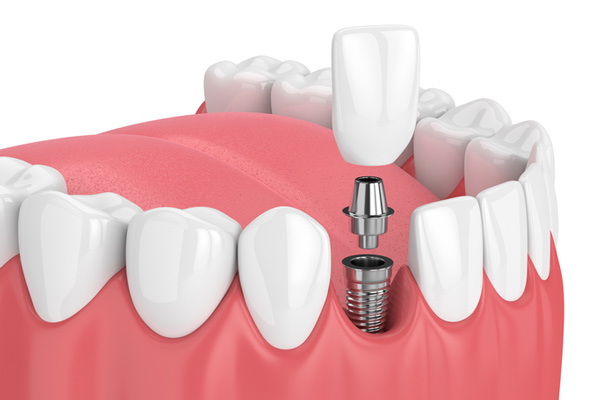 A rednering of a dental implant at Placentia Oral Surgery in Placentia, CA