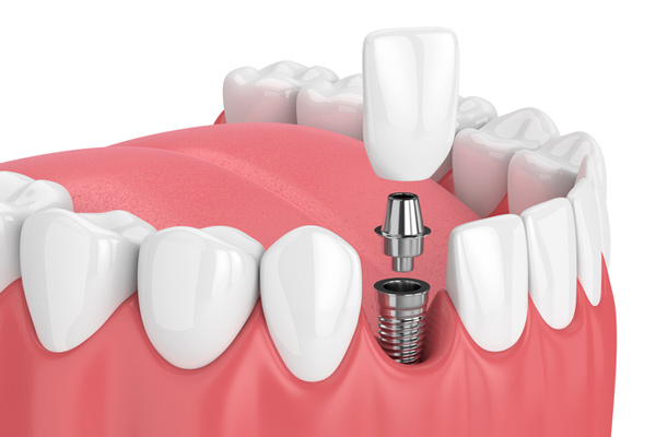A rednering of a dental implant at Placentia Oral Surgery in Placentia, CA A rednering of a dental implant at Placentia Oral Surgery in Placentia, CA