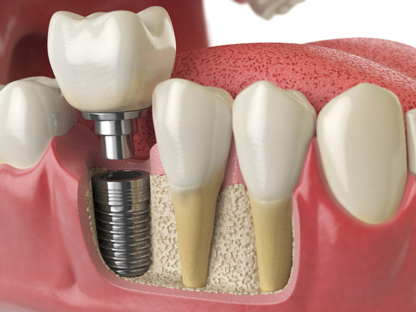 Diagram of dental implant in to jaw bone at  Placentia Oral Surgery in Placentia, CA