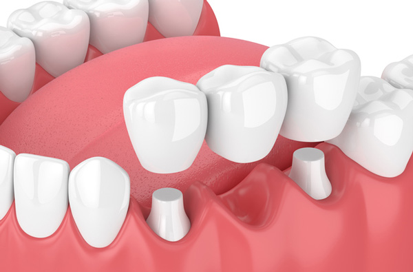 Rendering of jaw with dental bridge from Placentia Oral Surgery in Placentia, CA