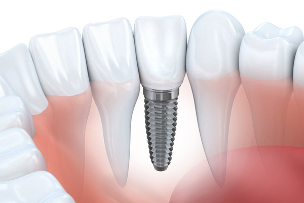 Diagram of dental implant in lower jaw
