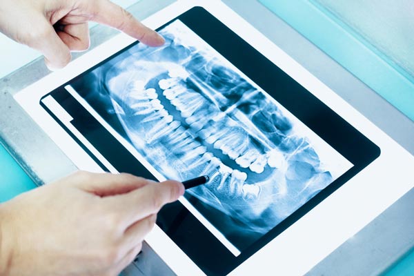 a dental xray of a full mouth at Placentia Oral Surgery in Placentia, CA