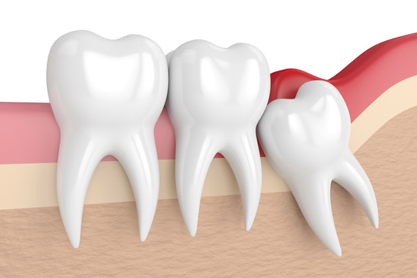 Illustration of an impacted wisdom tooth from Placentia Oral Surgery in Placentia,CA