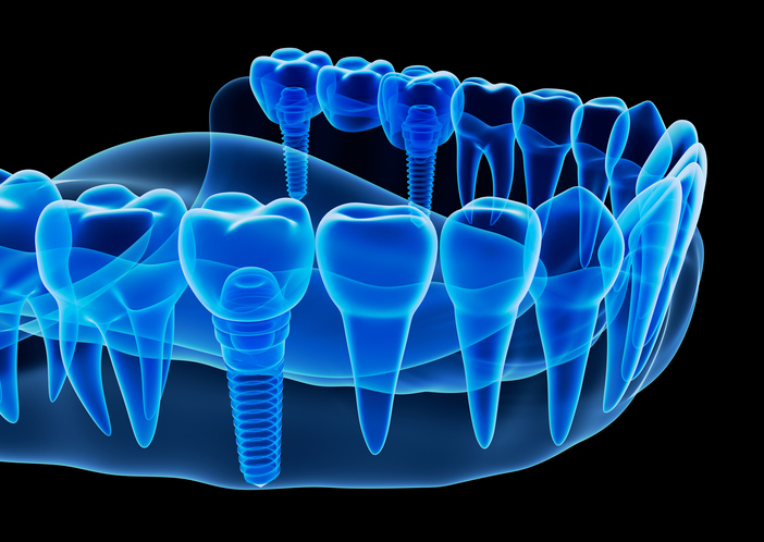 X-ray Model of multiple teeth dental implants from Placentia Oral Surgery in Placentia, CA